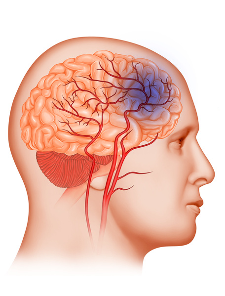 Trombose venosa cerebral: um tipo de AVC menos conhecido