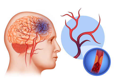 Trombose venosa cerebral: um tipo de AVC menos conhecido